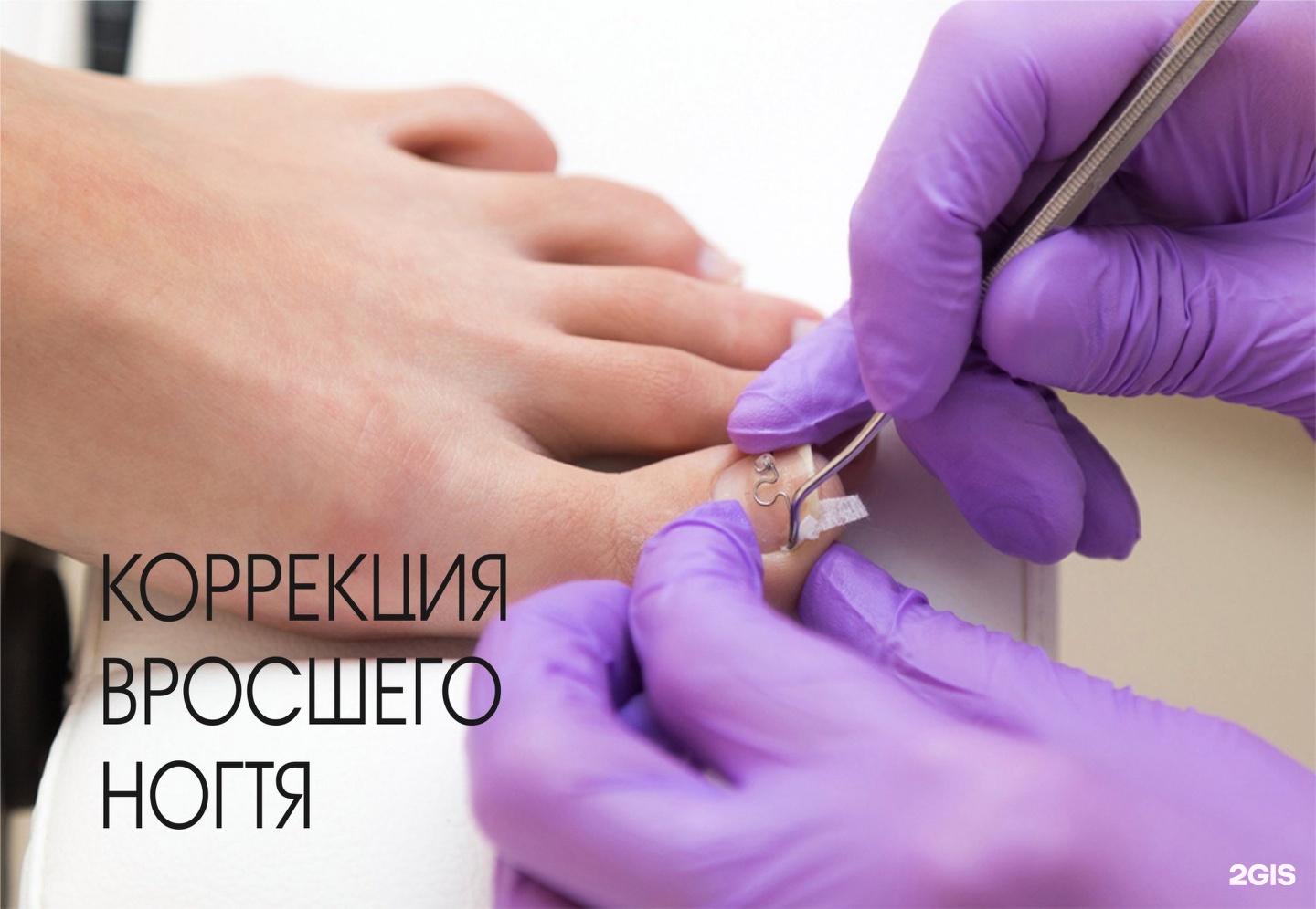 Чем удалить вросшийся ноготь Чем удалить вросшийся ноготь