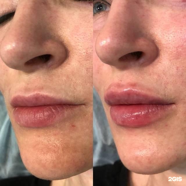 Lumeca. IPL Lumecca. Фотоомоложение на аппарате Lumecca. Lumecca фотоомоложение реабилитация.